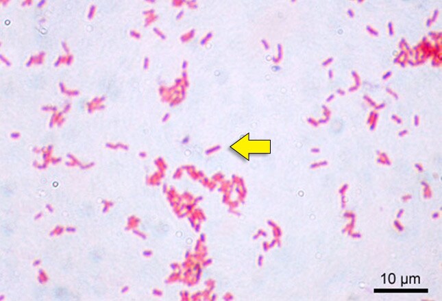prostatite lombalgia medscape